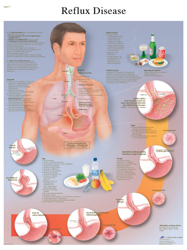 Gastroesophageal Reflux Disease Chart (GERD) #VR1711 for ...