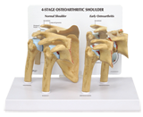 Human 4-stage Osteoarthritis (OA) Shoulder #1800