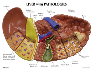 Human Liver Model with Pathologies #3310 for sale | Anatomy Now