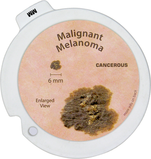 Malignant Melanoma