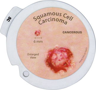 Squamous Cell Carcinoma