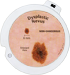 Dysplastic Nevus